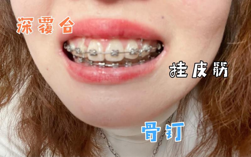 深圳深覆合正畸牙科推荐_深覆合医院能矫正吗_深覆合整牙价格