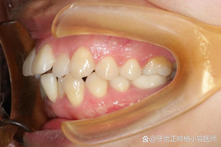 深覆合整牙价格_深覆合医院能矫正吗_深圳深覆合正畸牙科推荐